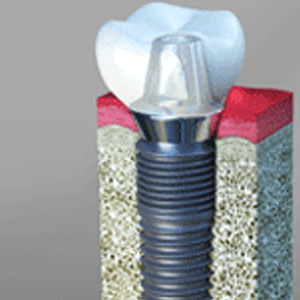 7 Signs You May Need Dental Implants in Linden 7 Signs You May Need Dental Implants in Linden