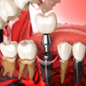 Comparing Different Types of Dental Implants in Linden