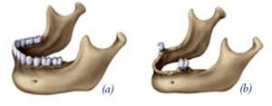 Bone Grafting Linden