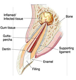 Root Canal Linden - Step 1