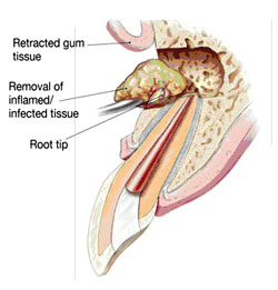 Root Canal Linden - Step 2