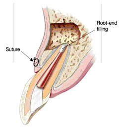 Root Canal Linden - Step 3