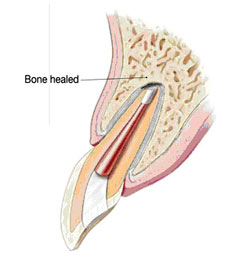 Root Canal Linden - Step 4