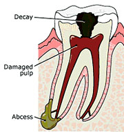 Root Canal Linden Procedure 1