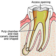 Root Canal Linden Procedure 2