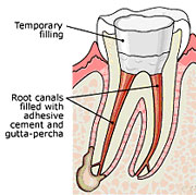 Root Canal Linden Procedure 3