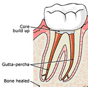 Root Canal Linden Procedure 4