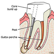 Root Canal Linden Procedure 5