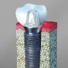 Dental Implants Linden