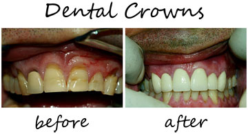 Dental Crowns 1