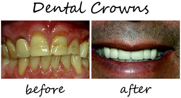 Dental Crowns 2