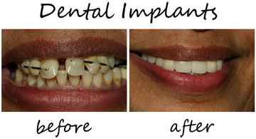 Dental Implants 1