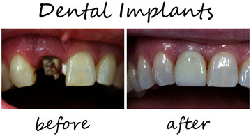 Dental Implants 2