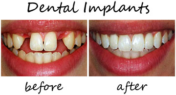 Dental Implants 3