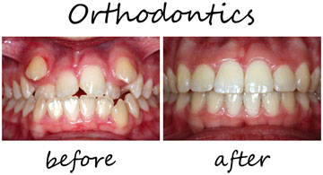 Orthodontics 4