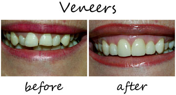 Veneers 2