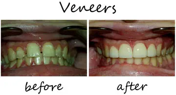 Veneers 3